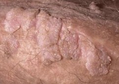 hpv virusu tedavisi)