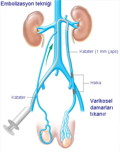 Varisemboli